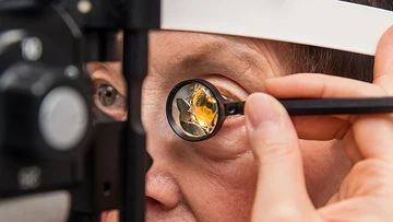 Glaucoma